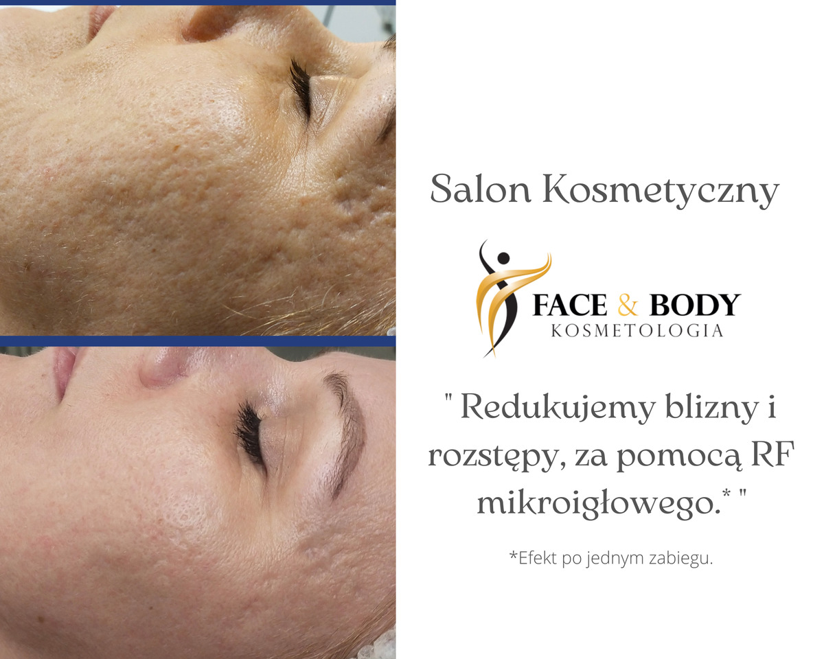 Redukcja blizn i rozstępów w Salonie kosmetycznym Kosmetologia Face & Body w Andrychowie
