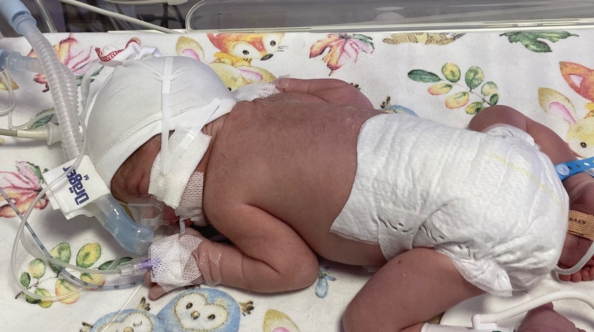 Maleńki Oliwierek urodził się tydzień temu, a już musiał przejść operację ratującą życie